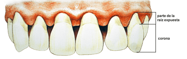 periodontitis y las enfermedades cardiovasculares