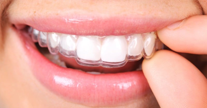 La ortodoncia - Centro odontologico valenciano
