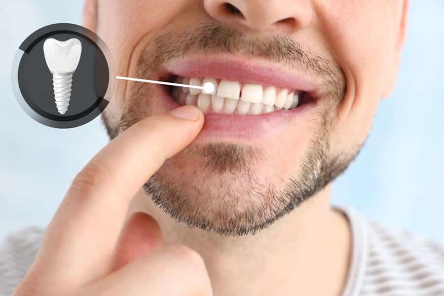 Clinica Dental Especializada en Implantes Dentales