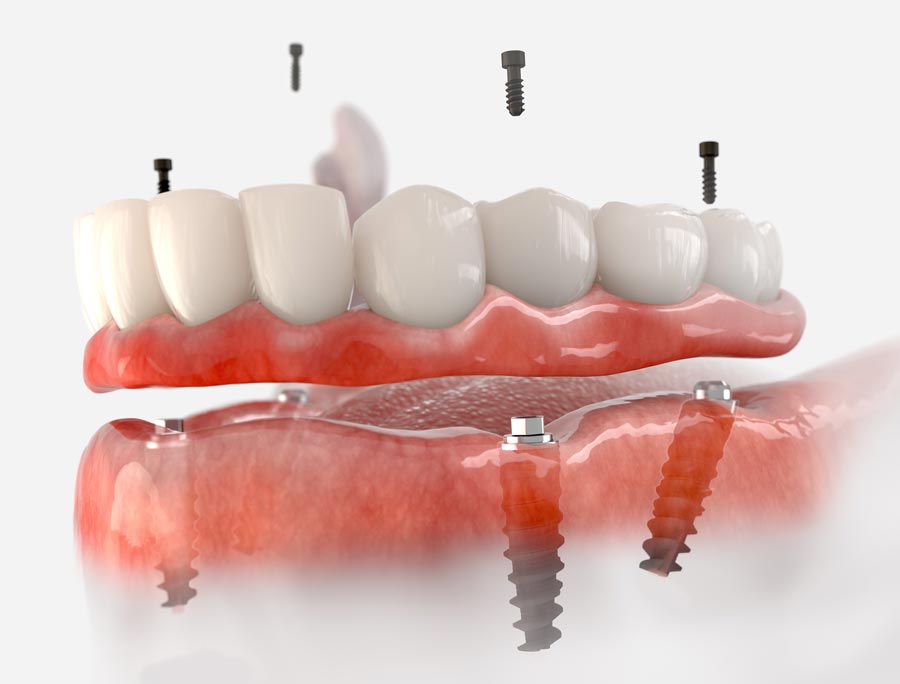 Implantes Dentales en un Solo Día