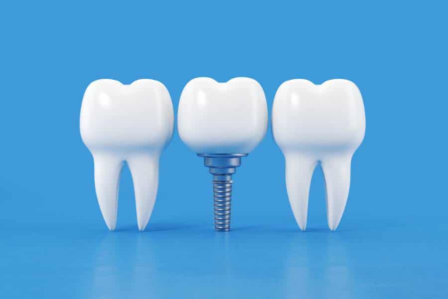 Importancia de reemplazar los dientes faltantes para una buena salud bucal