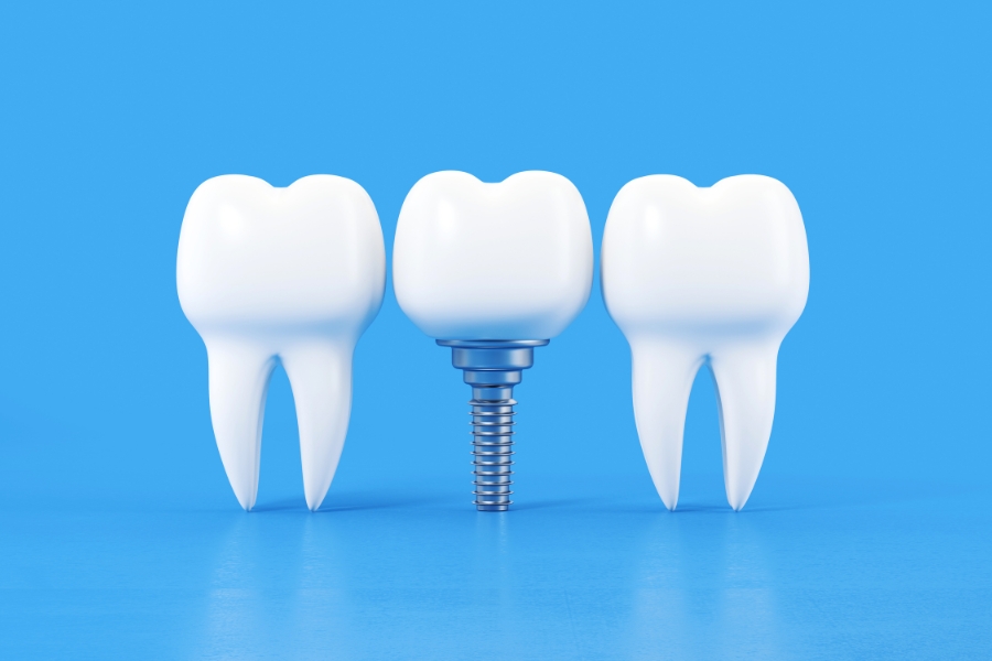 Clínicas de implantes dentales Valencia