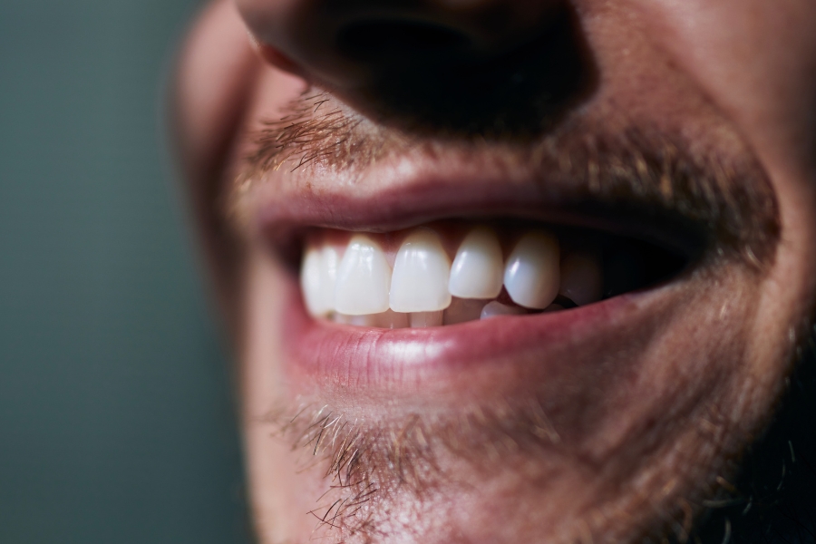 Carillas dentales, qué son y ventajas tienen