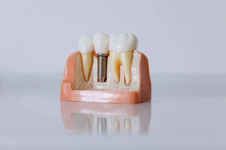 Cuáles son las ventajas de los implantes dentales