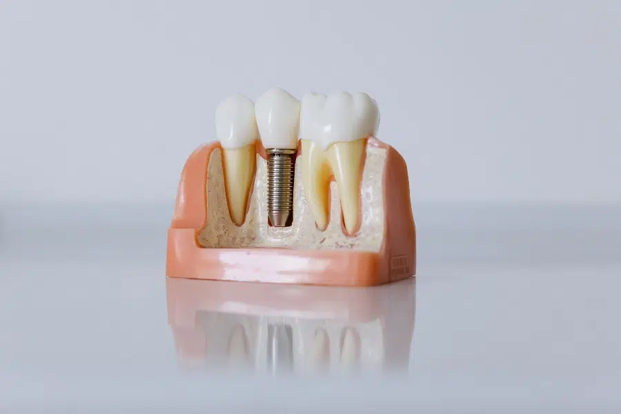 Cuáles son las ventajas de los implantes dentales