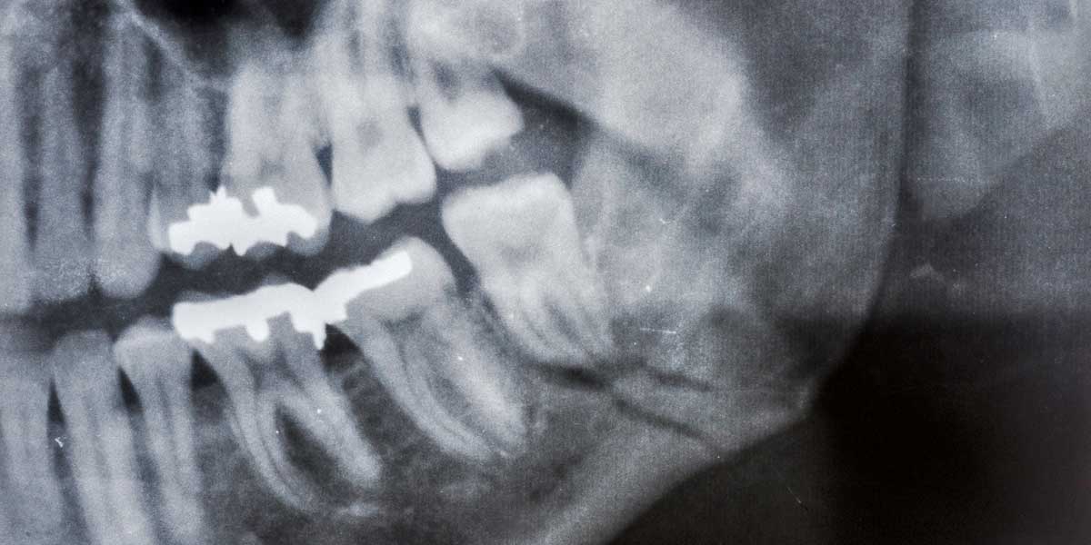 Implantes-dentales-y-pérdida-de-hueso