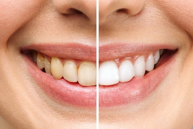alimentos que manchan los dientes