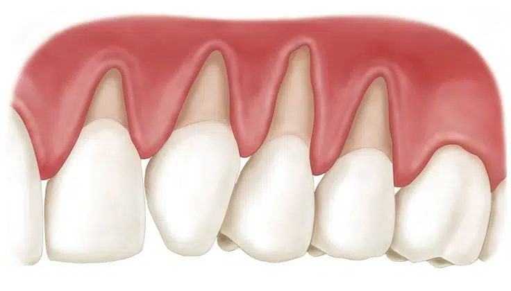 periodontitis