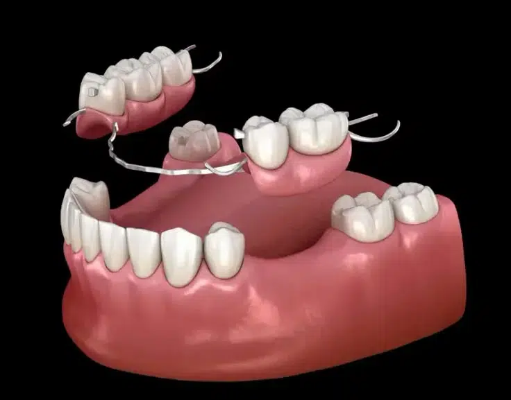protesis dental removible
