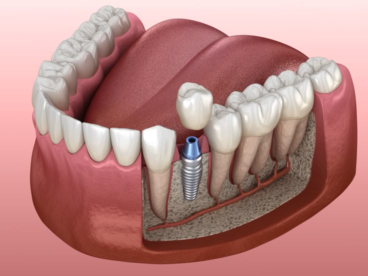 implante dental
