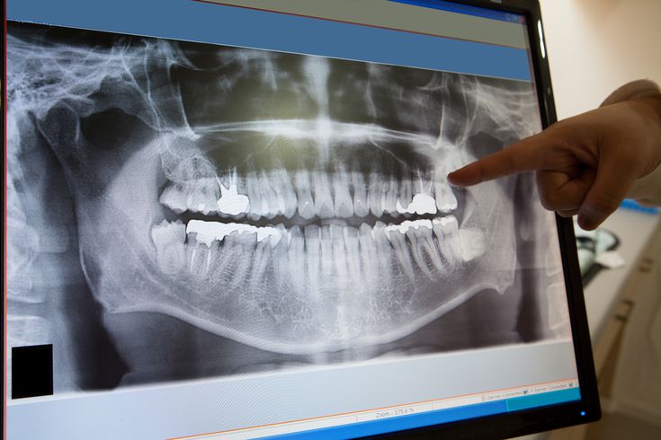 radiografía dental digital